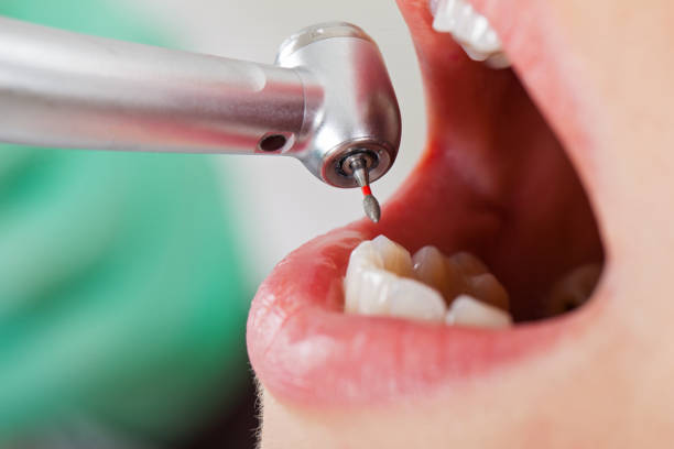Best Emergency Wisdom Teeth Removal in Redmond, WA